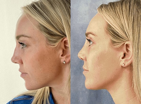 Rhinoplasty Before And After Photos By Dr. Demetri Arnaoutakis In Tampa, Fl Rhinoplasty Before And After Photos By Dr. Demetri Arnaoutakis In Tampa, Fl