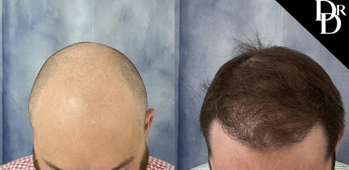 Hair Transplant Before And After Photos By Dr. Demetri Arnaoutakis In Tampa, Fl