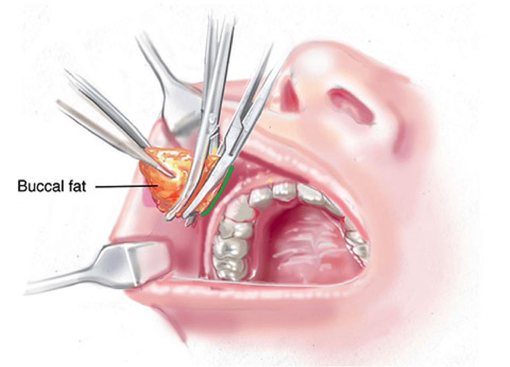 Buccal Fat Pad Removal