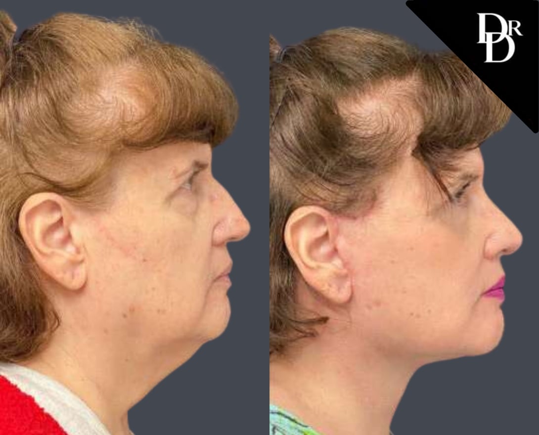 Dr. Demetri Facelift Before And After Results