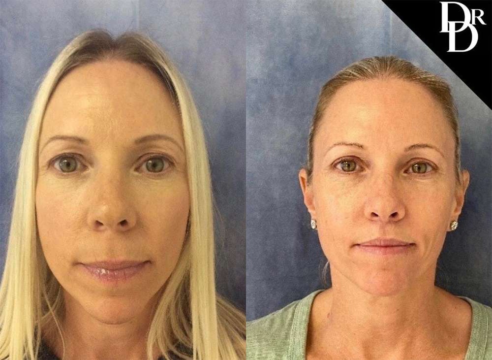 Eyelid Surgery Before And After Photos By Dr. Demetri Arnaoutakis In Tampa, Fl