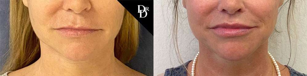 Lip Lift Before And After Photos By Dr. Demetri Arnaoutakis In Tampa, Fl