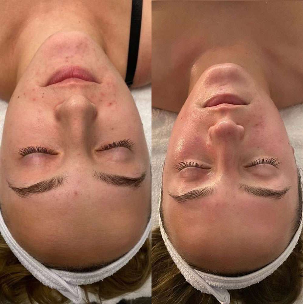 Microneedling Before And After Photos By Dr. Demetri Arnaoutakis In Tampa, Fl