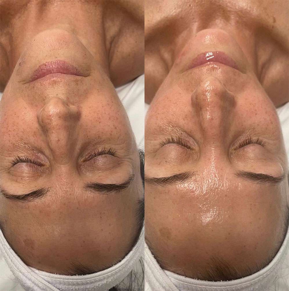 Microneedling Before And After Photos By Dr. Demetri Arnaoutakis In Tampa, Fl
