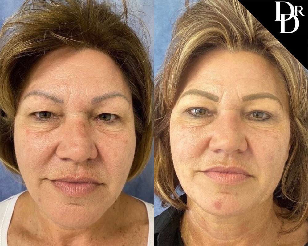 Eyelid Surgery Before And After Photos By Dr. Demetri Arnaoutakis In Tampa, Fl
