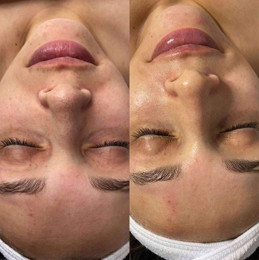 Microneedling Before And After Photos By Dr. Demetri Arnaoutakis In Tampa, Fl