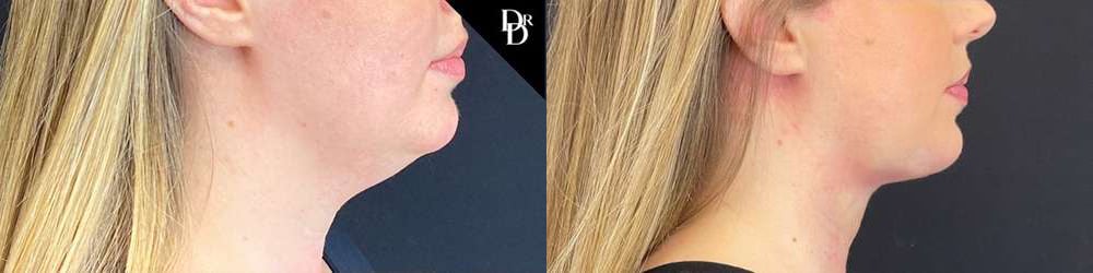 Facetite Before And After Photos By Dr. Demetri Arnaoutakis In Tampa, Fl