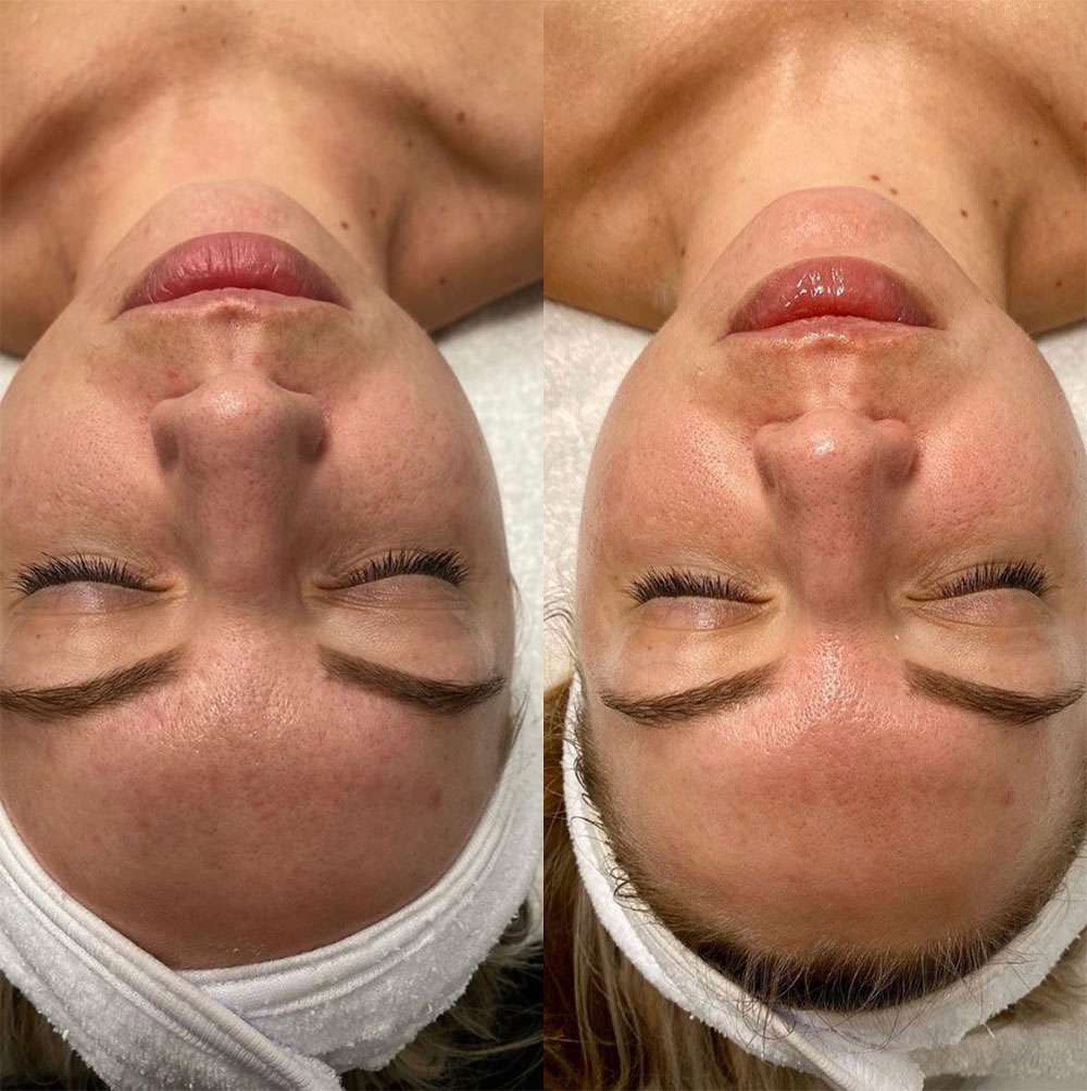 Microneedling Before And After Photos By Dr. Demetri Arnaoutakis In Tampa, Fl