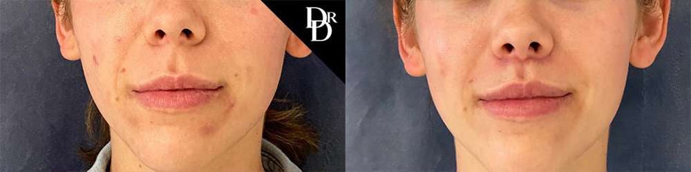 Lip Lift Before And After Photos By Dr. Demetri Arnaoutakis In Tampa, Fl