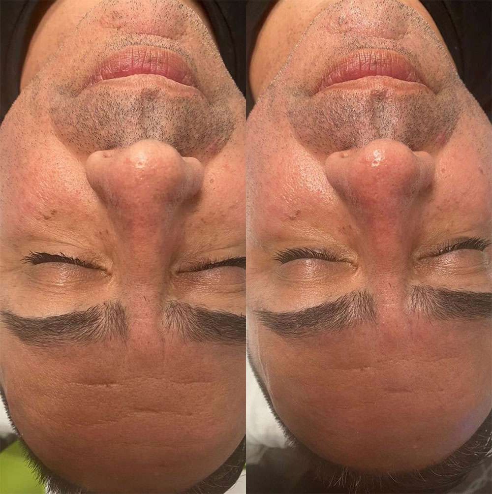 Microneedling Before And After Photos By Dr. Demetri Arnaoutakis In Tampa, Fl