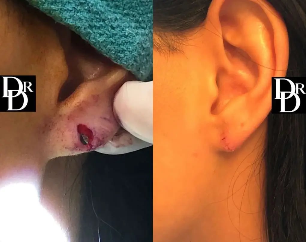 Earlobe Repair Before And After Photos By Dr Demetri Arnaoutakis In Tampa Fl X ()
