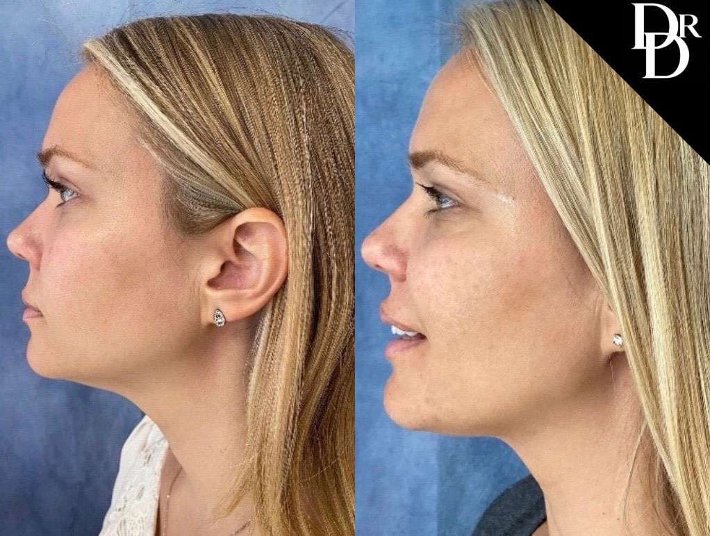 Facetite Before And After Photos By Dr. Demetri Arnaoutakis In Tampa, Fl