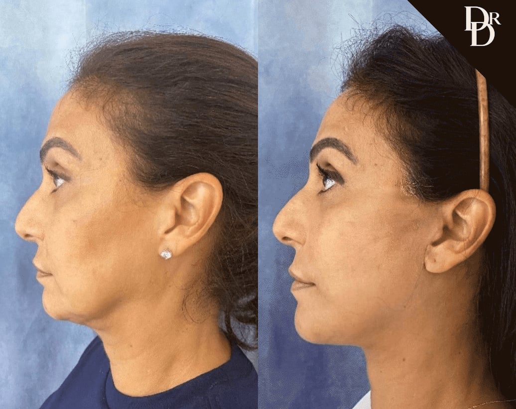 Neck Lift Before And After Photos By Dr. Demetri Arnaoutakis In Tampa, Fl