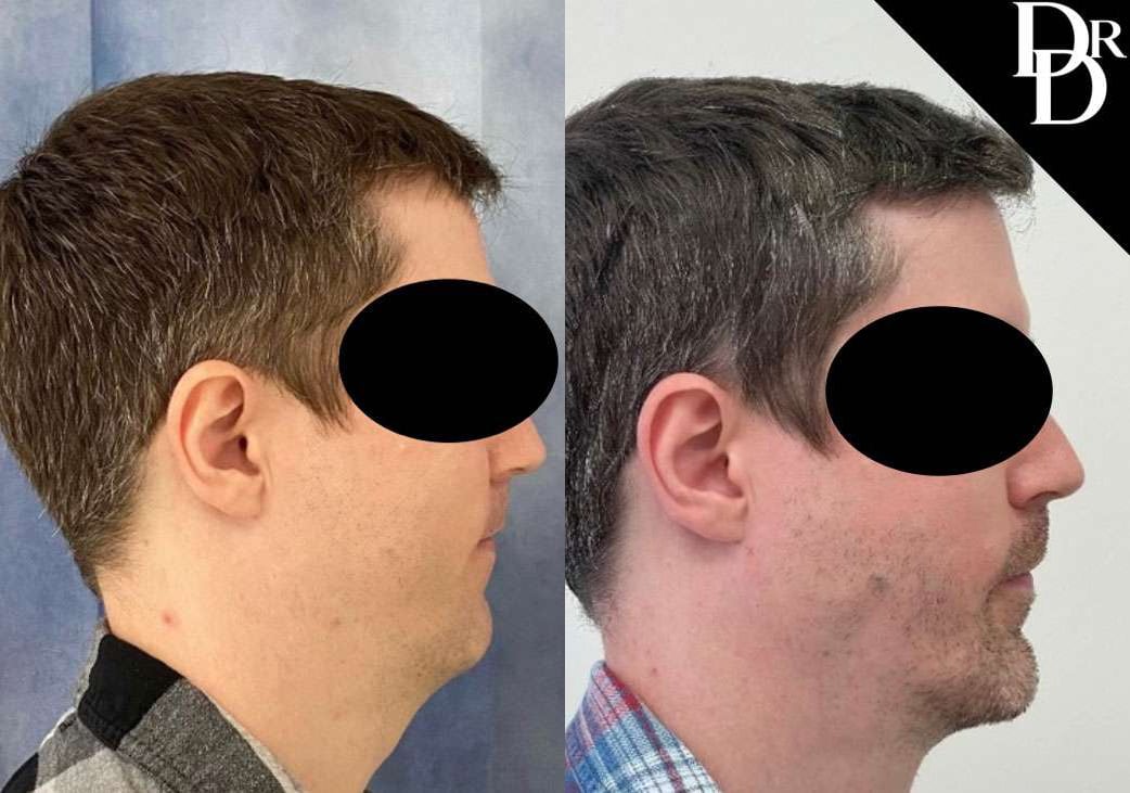Chin Augmentation Before And After Photos By Dr. Demetri Arnaoutakis In Tampa, Fl