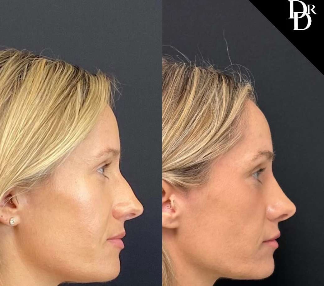Rhinoplasty Before And After Photos By Dr. Demetri Arnaoutakis In Tampa, Fl