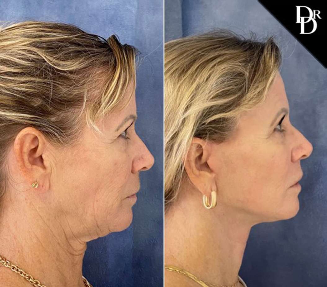 Facelift Before And After Photos By Dr. Demetri Arnaoutakis In Tampa, Fl