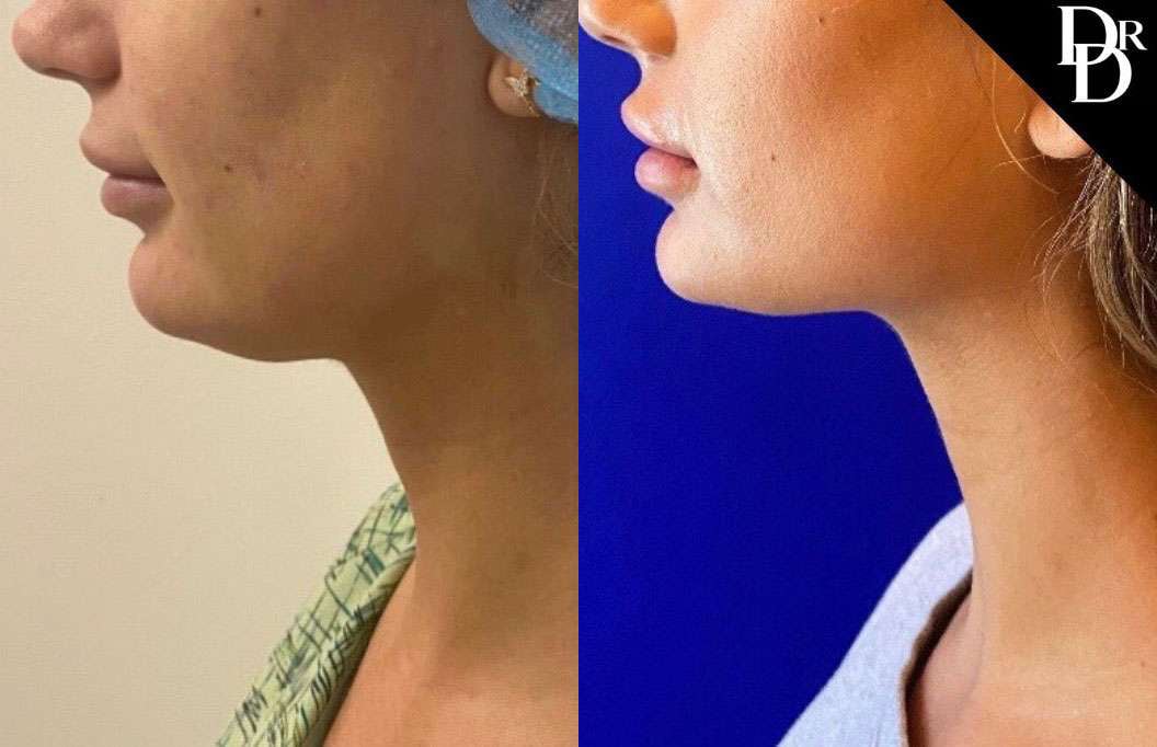 Neck Lift Before And After Photos By Dr. Demetri Arnaoutakis In Tampa, Fl