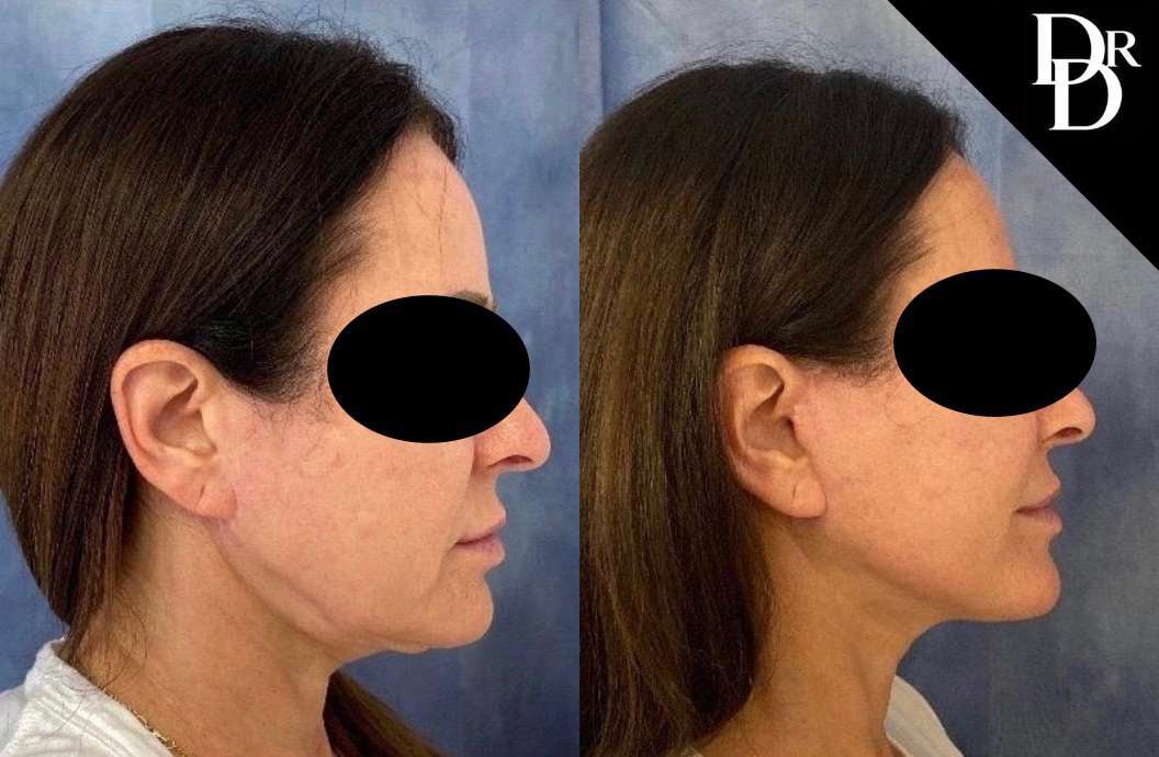 Neck Lift Before And After Photos By Dr. Demetri Arnaoutakis In Tampa, Fl