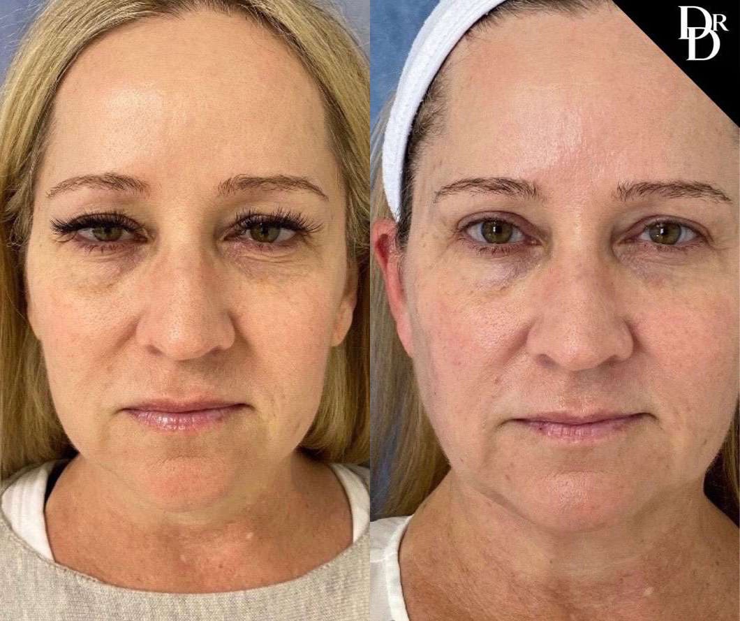 Eyelid Surgery Before And After Photos By Dr. Demetri Arnaoutakis In Tampa, Fl