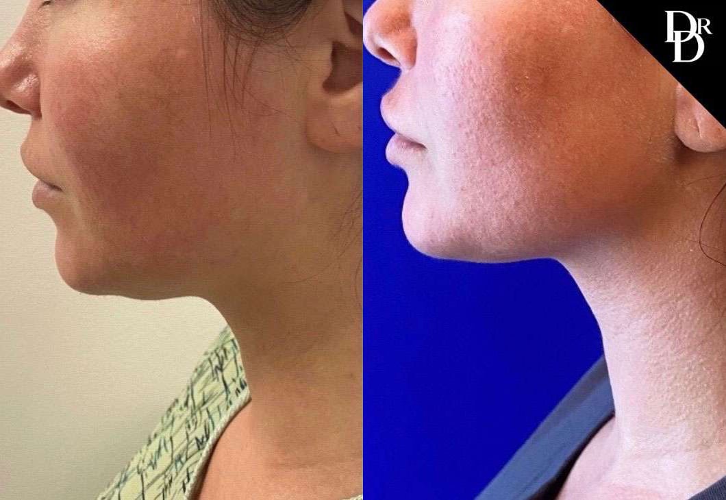 Neck Lift Before And After Photos By Dr. Demetri Arnaoutakis In Tampa, Fl
