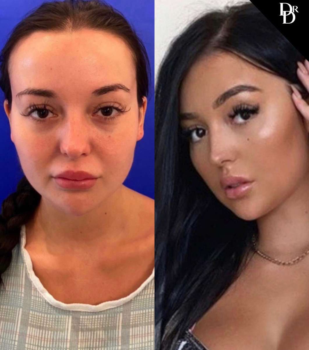 Hairline Lowering Surgery Before And After Photos By Dr. Demetri Arnaoutakis In Tampa, Fl