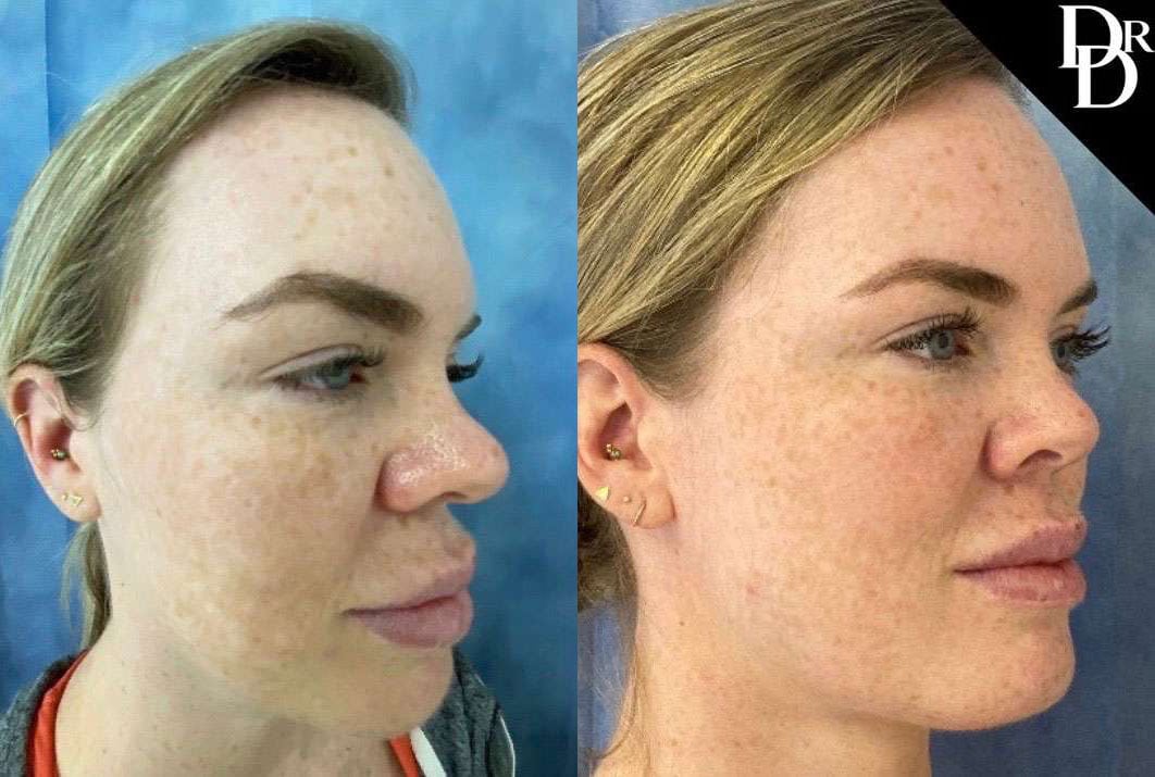 Neck Lift Before And After Photos By Dr. Demetri Arnaoutakis In Tampa, Fl
