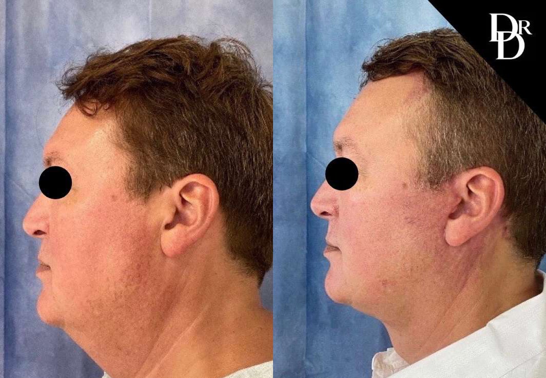 Neck Lift Before And After Photos By Dr. Demetri Arnaoutakis In Tampa, Fl