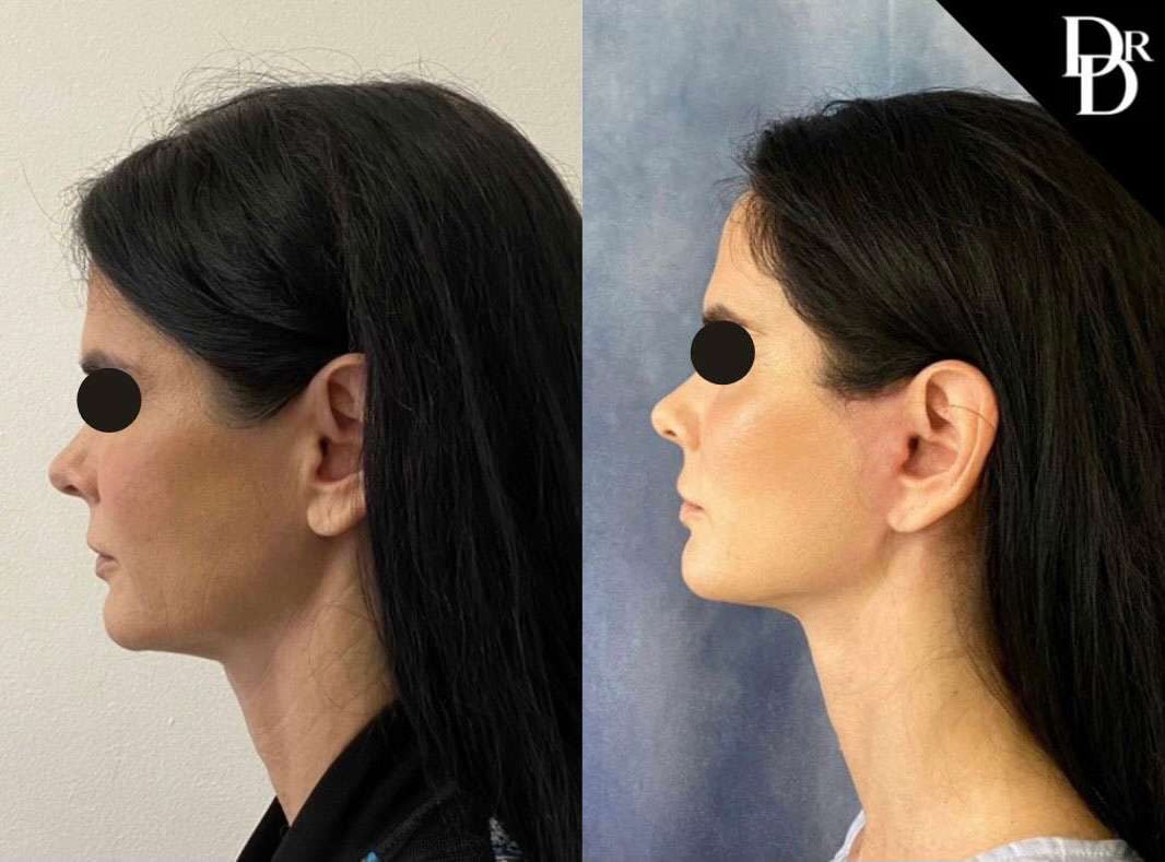 Neck Lift Before And After Photos By Dr. Demetri Arnaoutakis In Tampa, Fl