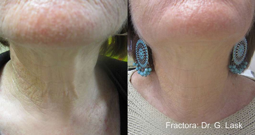 Facetite Before And After Photos By Dr. Demetri Arnaoutakis In Tampa, Fl