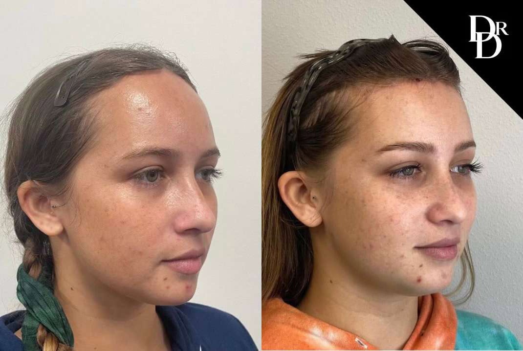 Hairline Lowering Surgery Before And After Photos By Dr. Demetri Arnaoutakis In Tampa, Fl