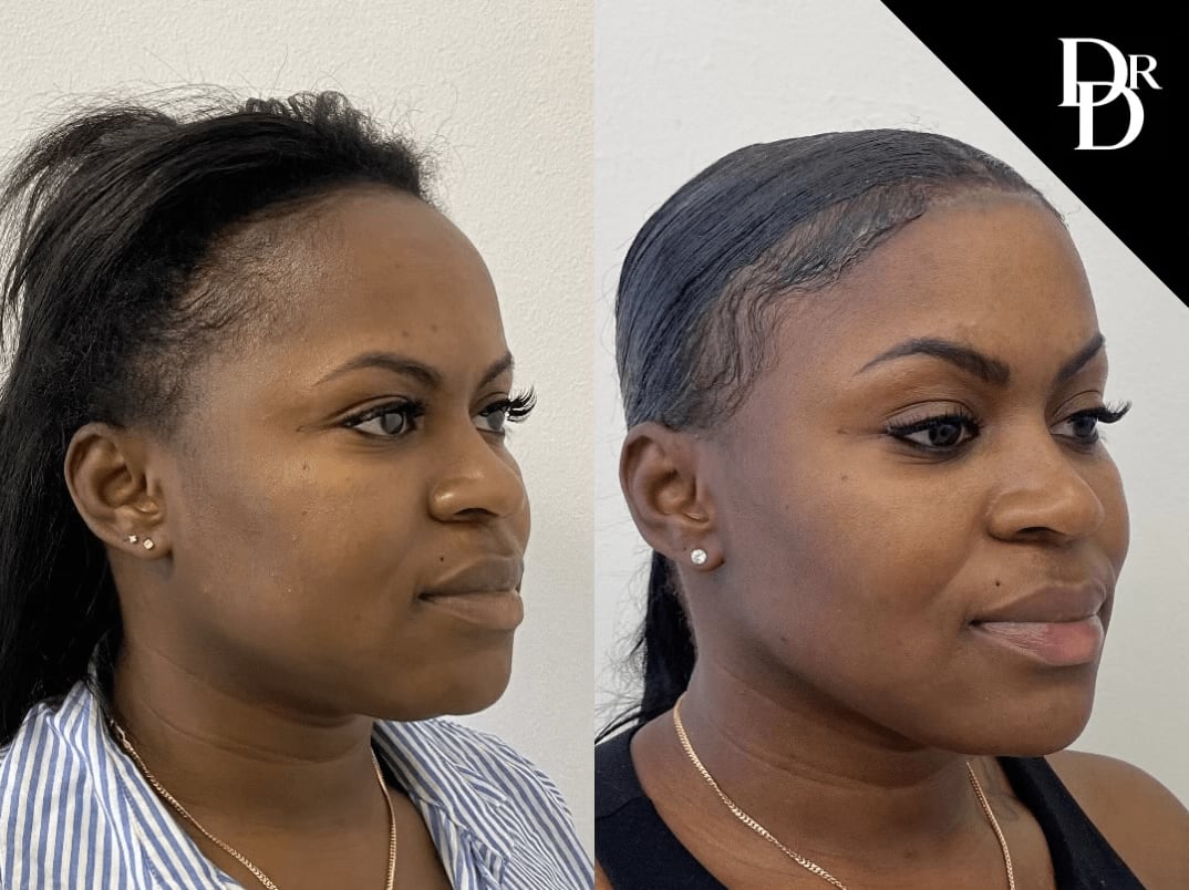Hairline Lowering Surgery Before And After Photos By Dr. Demetri Arnaoutakis In Tampa, Fl