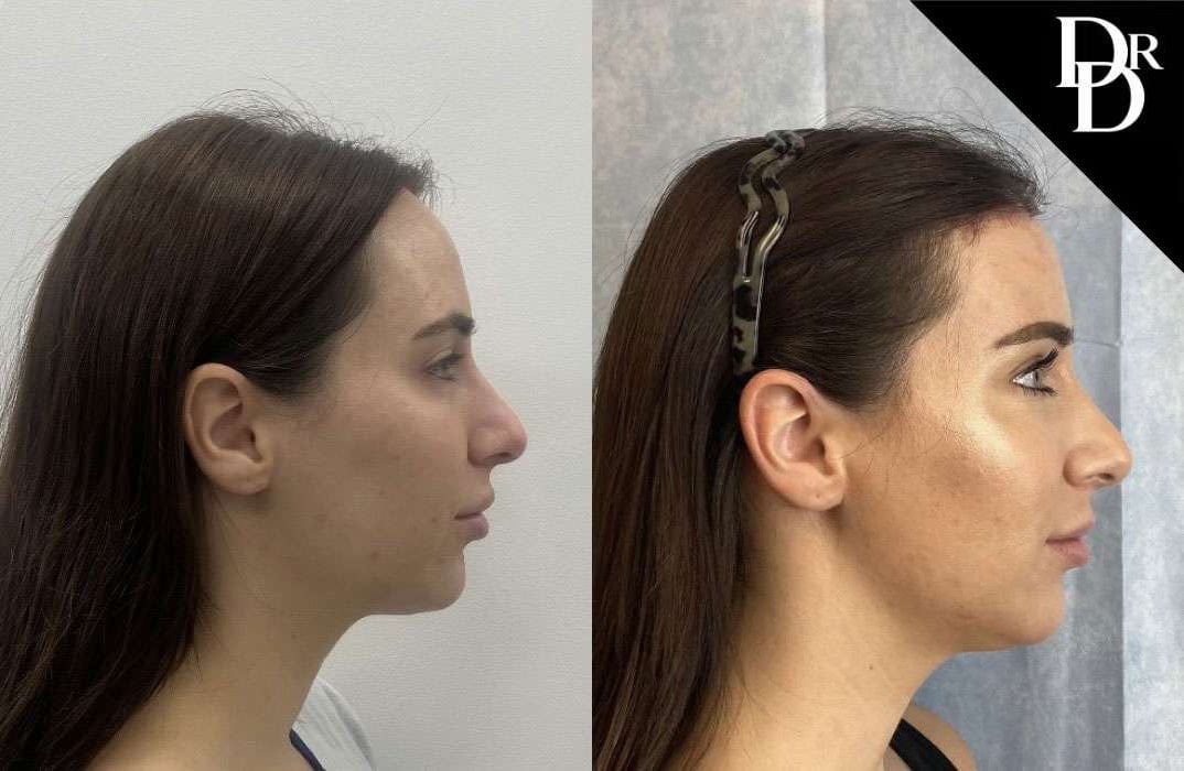 Hairline Lowering Surgery Before And After Photos By Dr. Demetri Arnaoutakis In Tampa, Fl
