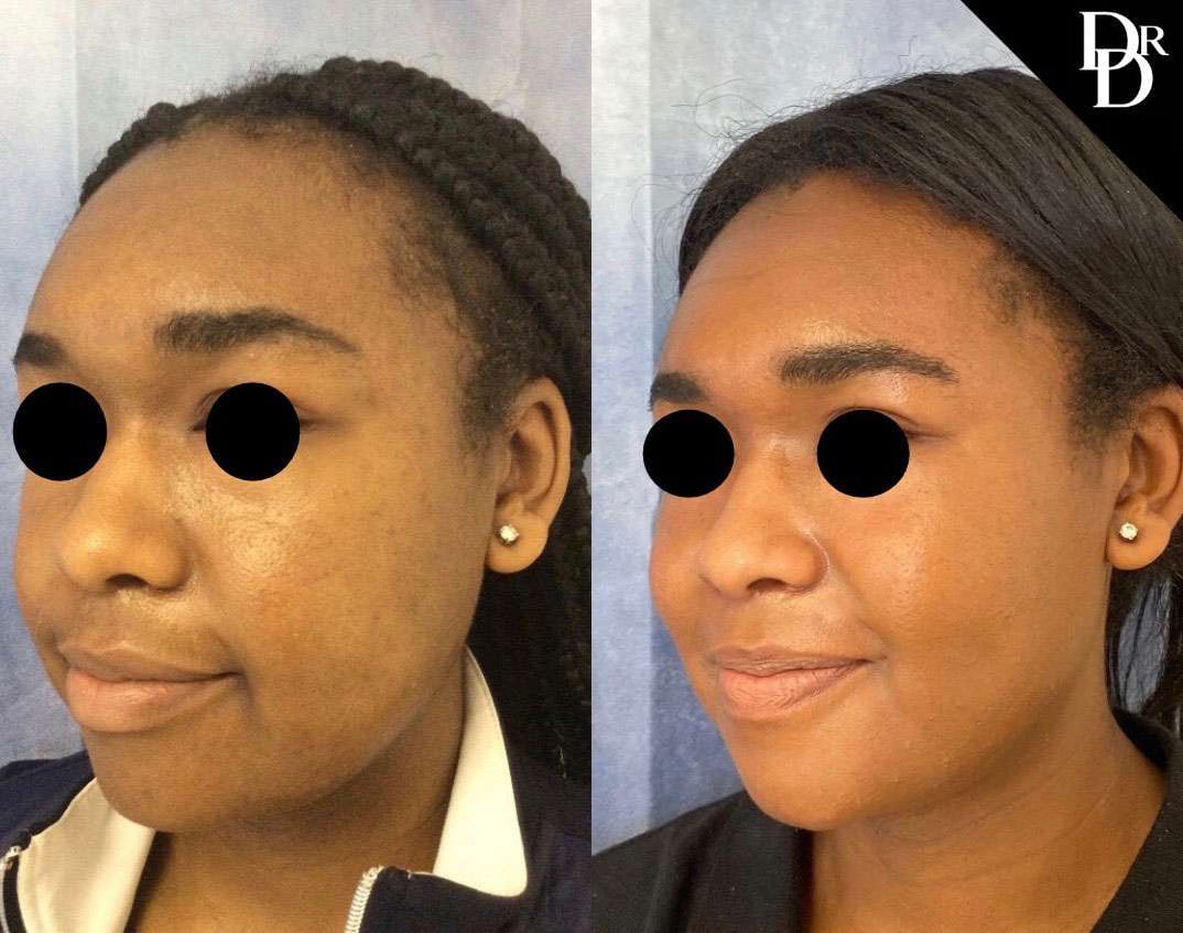 Buccal Fat Pad Removal Before And After Photos By Dr. Demetri Arnaoutakis In Tampa, Fl