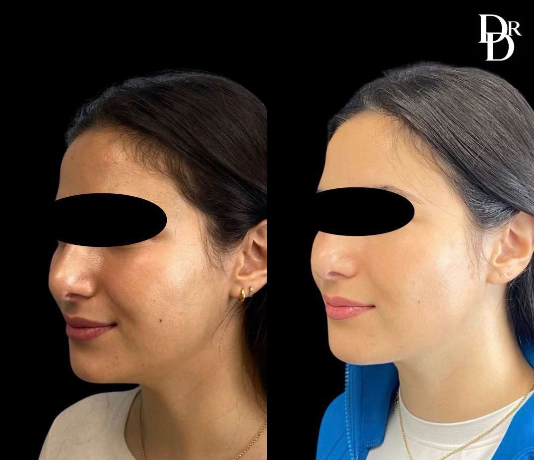 Morpheus8 Before And After Photos By Dr. Demetri Arnaoutakis In Tampa, Fl