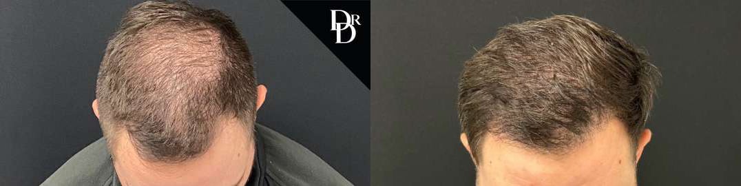 Hair Transplant Before And After Photos By Dr. Demetri Arnaoutakis In Tampa, Fl