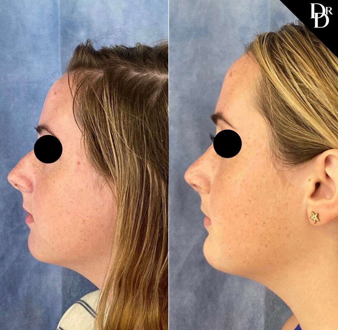 Rhinoplasty Before And After Photos By Dr. Demetri Arnaoutakis In Tampa, Fl