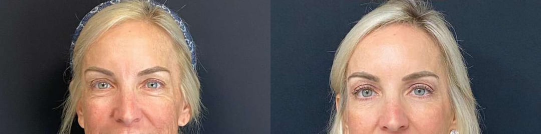 Eyelid Surgery Before And After Photos By Dr. Demetri Arnaoutakis In Tampa, Fl