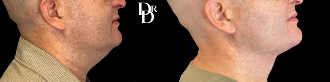 Facetite Before And After Photos By Dr. Demetri Arnaoutakis In Tampa, Fl