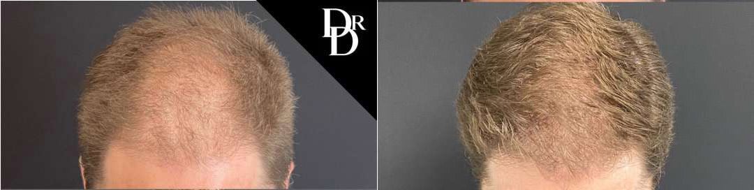 Hair Transplant Before And After Photos By Dr. Demetri Arnaoutakis In Tampa, Fl