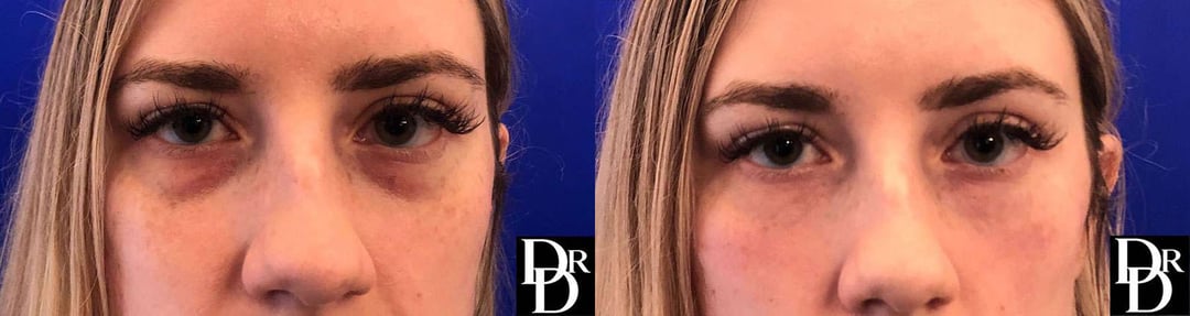 Injectable/Dermal Fillers Before And After Photos By Dr. Demetri Arnaoutakis In Tampa, Fl