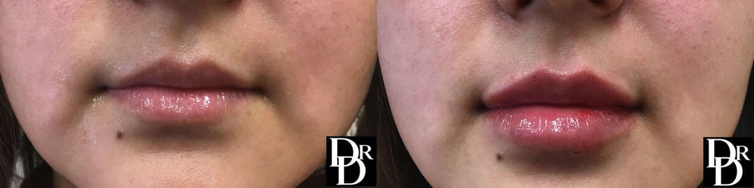 Injectable/Dermal Fillers Before And After Photos By Dr. Demetri Arnaoutakis In Tampa, Fl