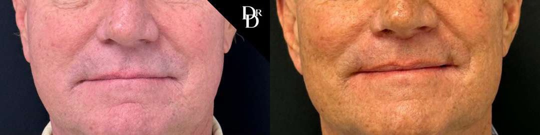 Lip Lift Before And After Photos By Dr. Demetri Arnaoutakis In Tampa, Fl