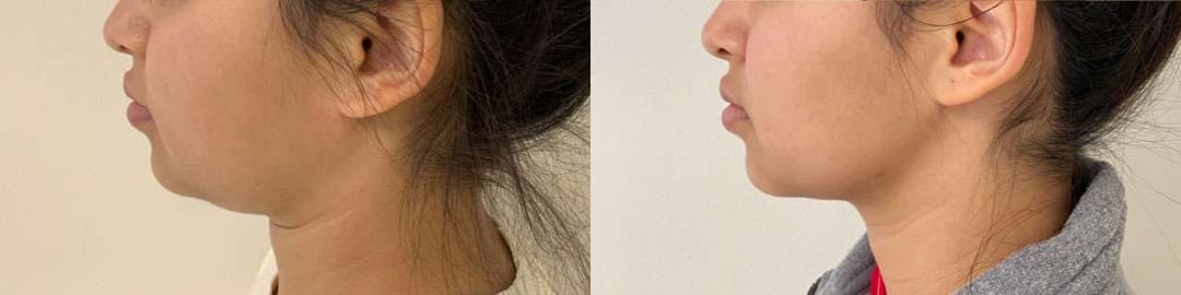 Buccal Fat Pad Removal Before And After Photos By Dr. Demetri Arnaoutakis In Tampa, Fl