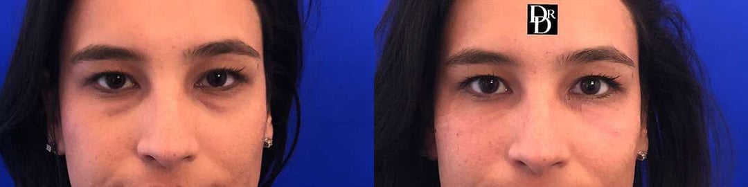 Injectable/Dermal Fillers Before And After Photos By Dr. Demetri Arnaoutakis In Tampa, Fl