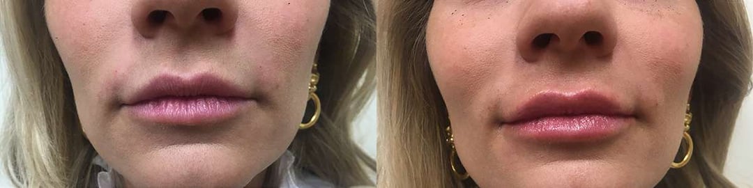 Injectable/Dermal Fillers Before And After Photos By Dr. Demetri Arnaoutakis In Tampa, Fl