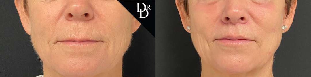 Lip Lift Before And After Photos By Dr. Demetri Arnaoutakis In Tampa, Fl