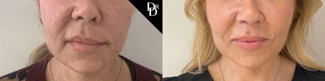 Morpheus8 Before And After Photos By Dr. Demetri Arnaoutakis In Tampa, Fl