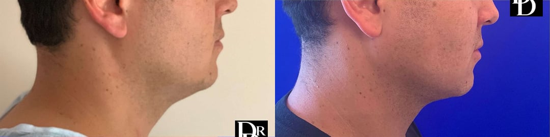 Neck Lift Before And After Photos By Dr. Demetri Arnaoutakis In Tampa, Fl