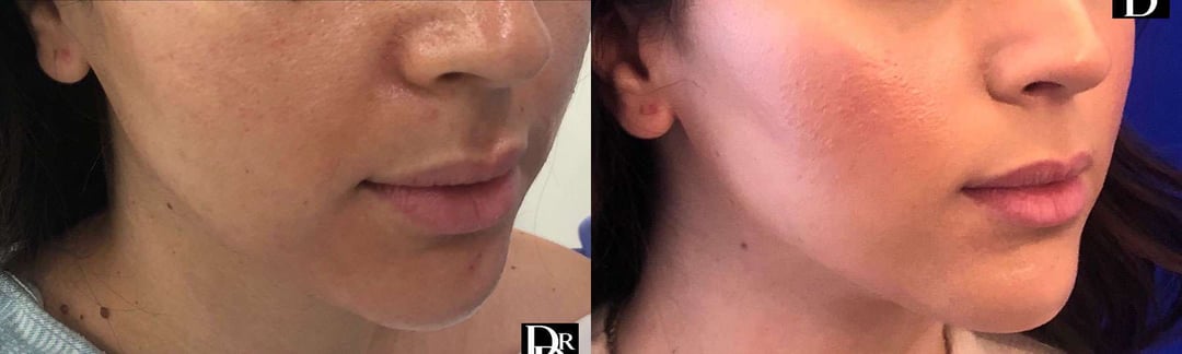 Buccal Fat Pad Removal Before And After Photos By Dr. Demetri Arnaoutakis In Tampa, Fl
