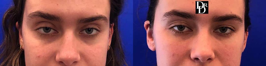 Injectable/Dermal Fillers Before And After Photos By Dr. Demetri Arnaoutakis In Tampa, Fl